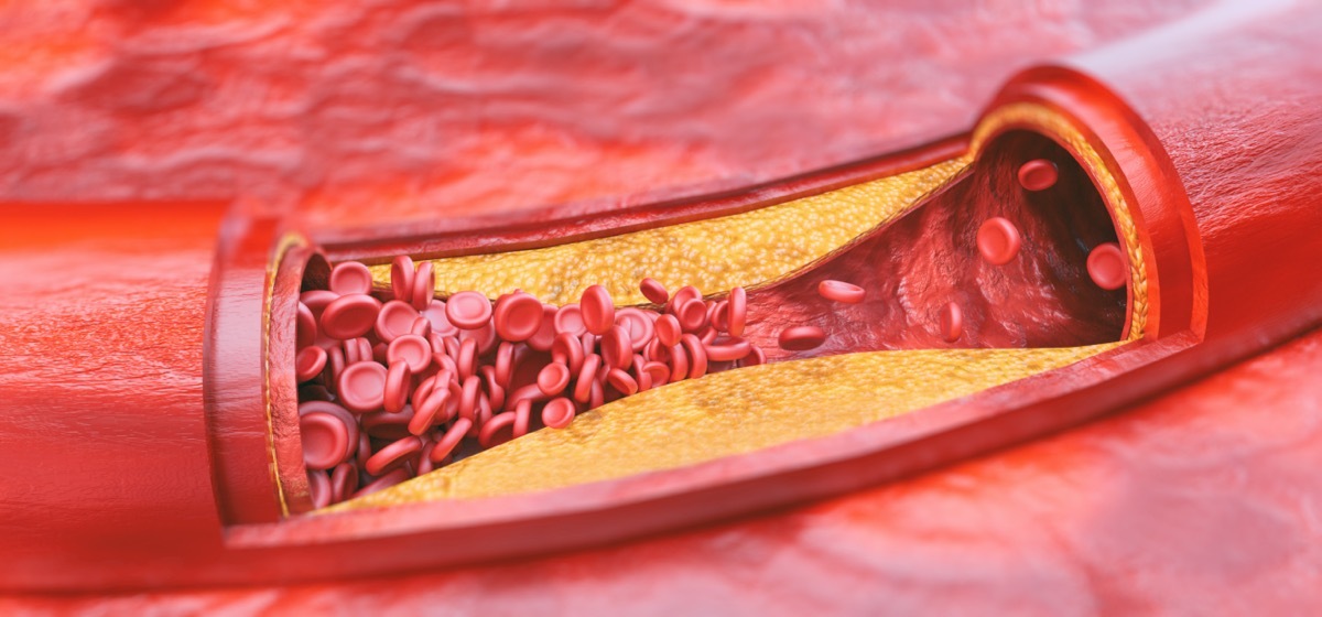 Closeup of a atherosclerosis - 3D rendering