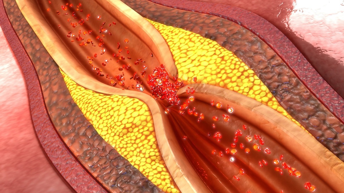 coronary artery plaque 3d illustration