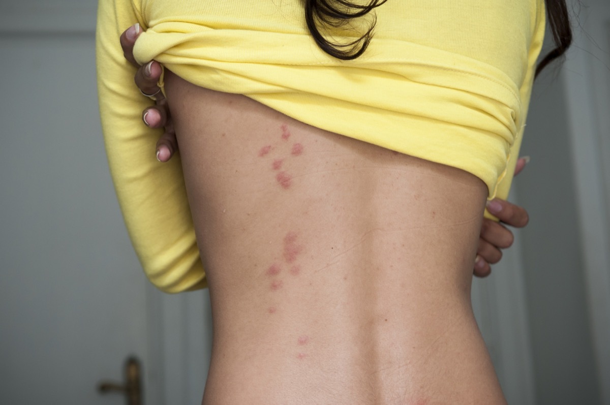 Woman with bed bug bites