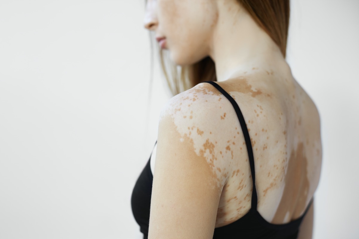 female model in black tank top suffering from vitiligo disorder