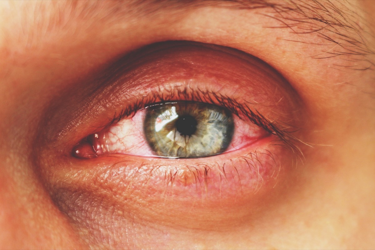 Man with pink eye conjunctivitis