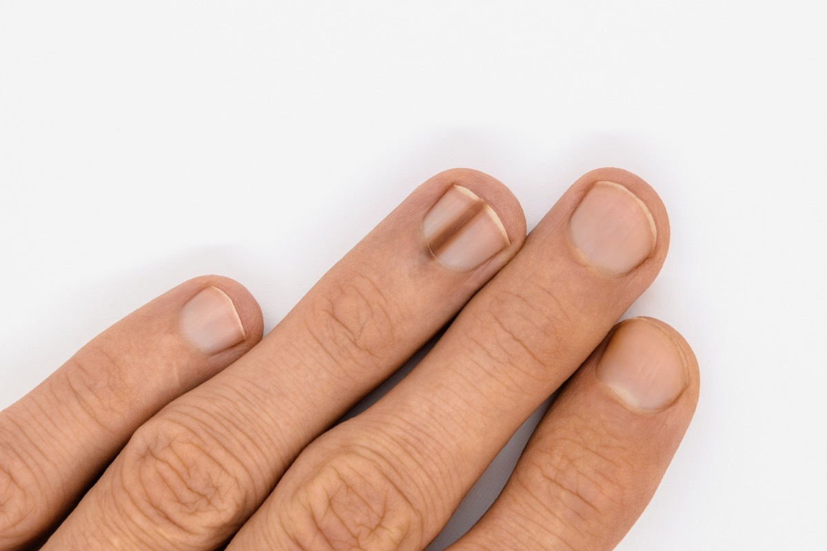 Nail with brown line