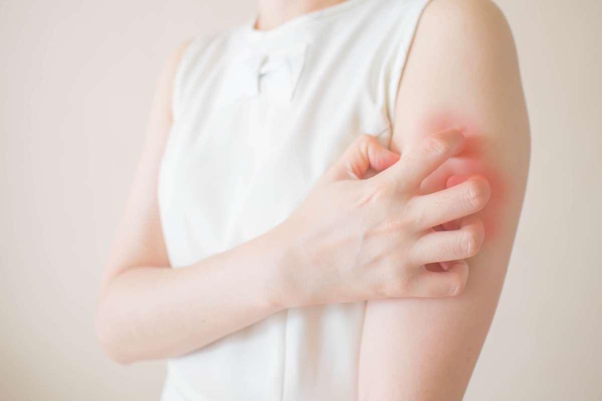 young woman, scratching arm, red rash, wearing white shirt